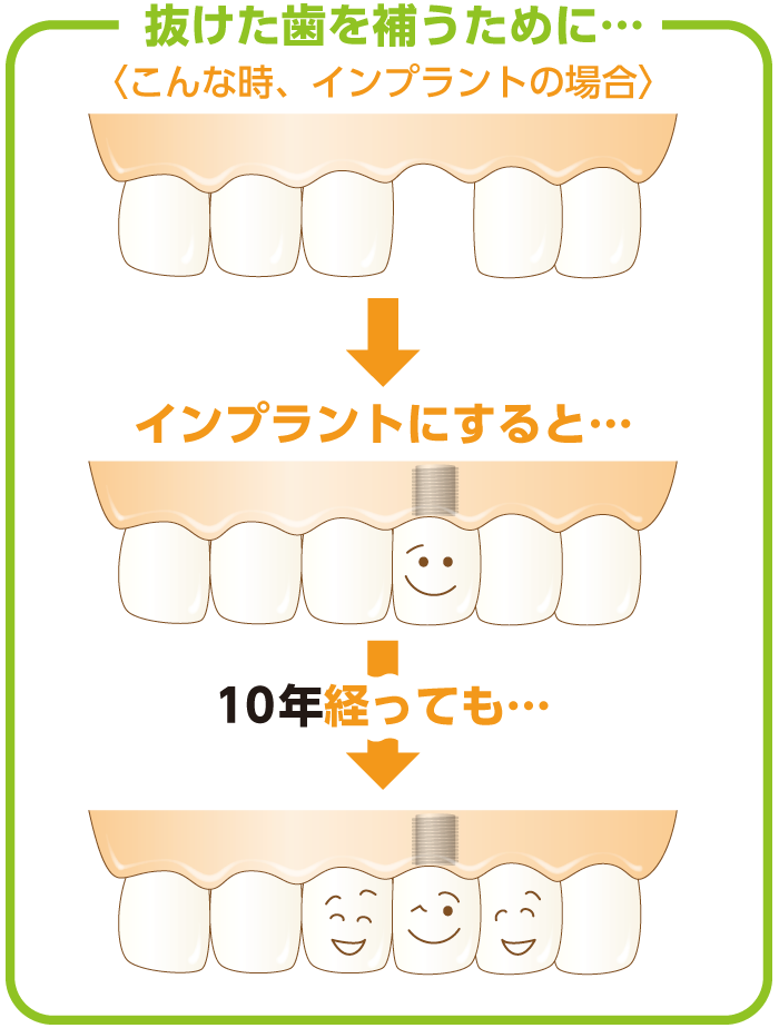インプラントにすると…10年経っても大丈夫