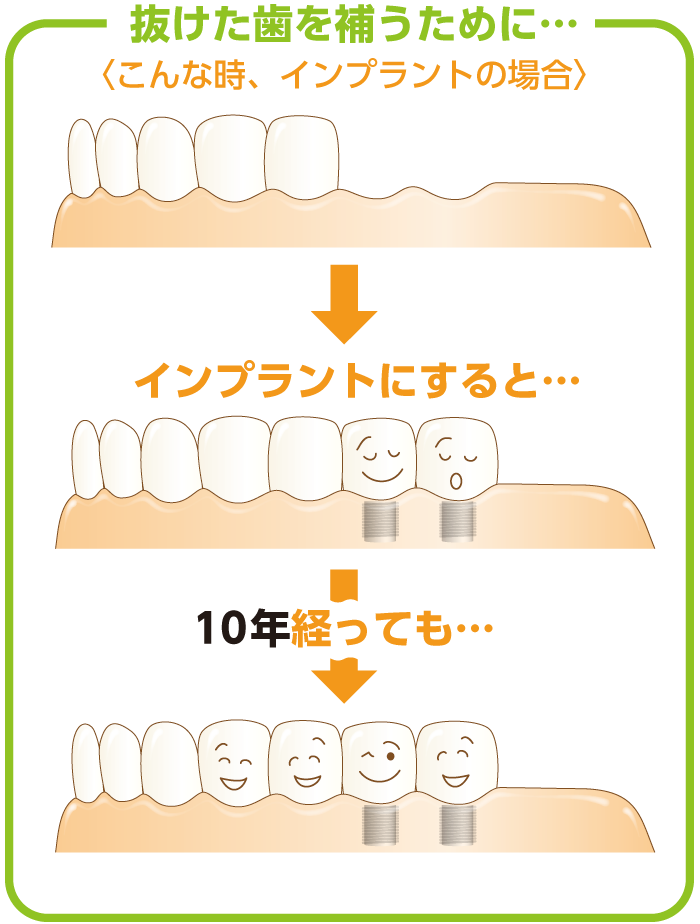 インプラントにすると…10年経っても大丈夫